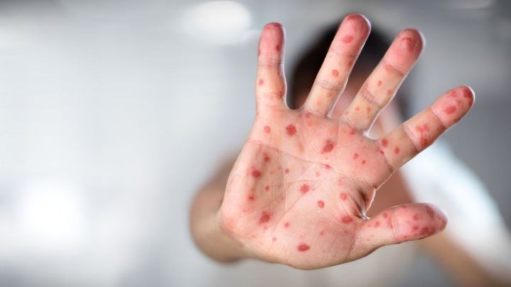 ΕΟΔΥ: Τρεις επιδημίες ιλαράς στην Ελλάδα, με 4.151 κρούσματα και 4 θανάτους