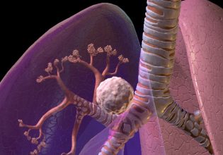 Καρκίνος: Δύο είναι οι βασικοί τομείς που δημιουργούν τις ανισότητες στη φροντίδα ασθενών