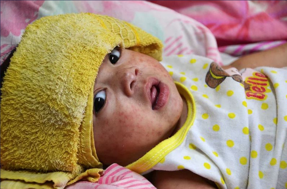 Μαγιορκίνης: Εξαιρετικά εκτεθειμένοι στην ιλαρά πληθυσμοί που δεν έχουν ολοκληρώσει τον εμβολιασμό
