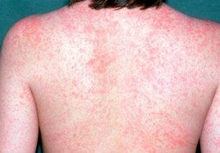 Ρήγμα στο τείχος ανοσίας για πρόληψη από ιλαρά