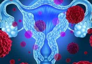 Μυστηριώδη «επιδημία» καρκίνων στην κοιλιά σε νεότερα άτομα βλέπουν οι ειδικοί