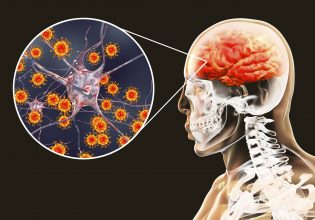 Μηνιγγίτιδα: 12 κρούσματα σε δύο μήνες – Τα συμπτώματα και οι προφυλάξεις