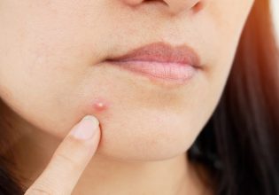 Reuters: Βρέθηκε καρκινογόνος ουσία σε γνωστά προϊόντα για την ακμή