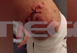 Ραφήνα: «Με έριξαν κάτω και άρχισαν να με δαγκώνουν» – Τι λέει η γυναίκα που δέχθηκε επίθεση από σκυλιά