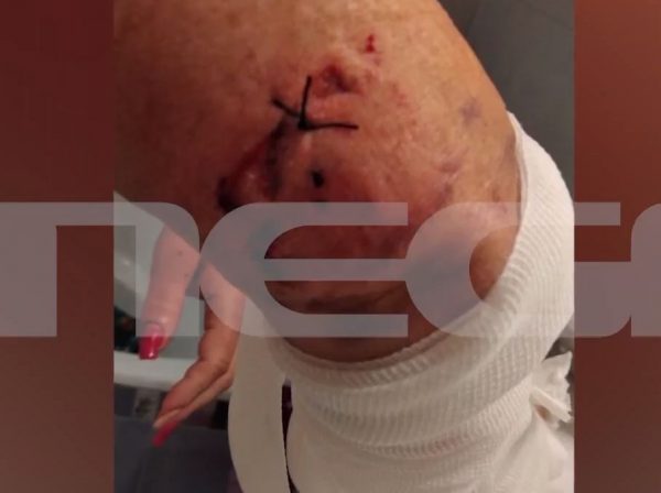 Ραφήνα: «Με έριξαν κάτω και άρχισαν να με δαγκώνουν» – Τι λέει η γυναίκα που δέχθηκε επίθεση από σκυλιά