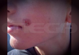 Πέλλα: Ακραίο bullying σε 14χρονο – Έσβηναν συχνά τσιγάρα πάνω του, είχαν προσπαθήσει να τον πνίξουν με ζακέτα