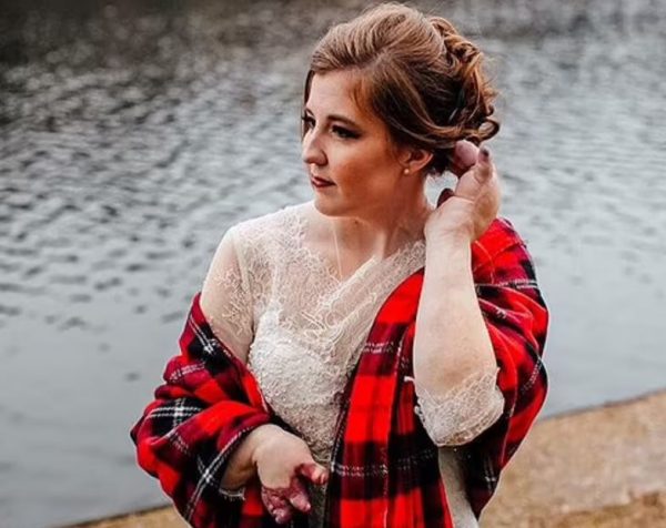 Τέξας: Γυναίκα γεννήθηκε με πρησμένα χέρια – Η εξαιρετικά σπάνια πάθηση που πλήττει 200 άτομα παγκοσμίως