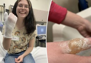 ΗΠΑ: Έφηβη έπαθε σοβαρά εγκαύματα αφού μιμήθηκε βίντεο στο TikTok