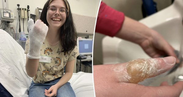 ΗΠΑ: Έφηβη έπαθε σοβαρά εγκαύματα αφού μιμήθηκε βίντεο στο TikTok