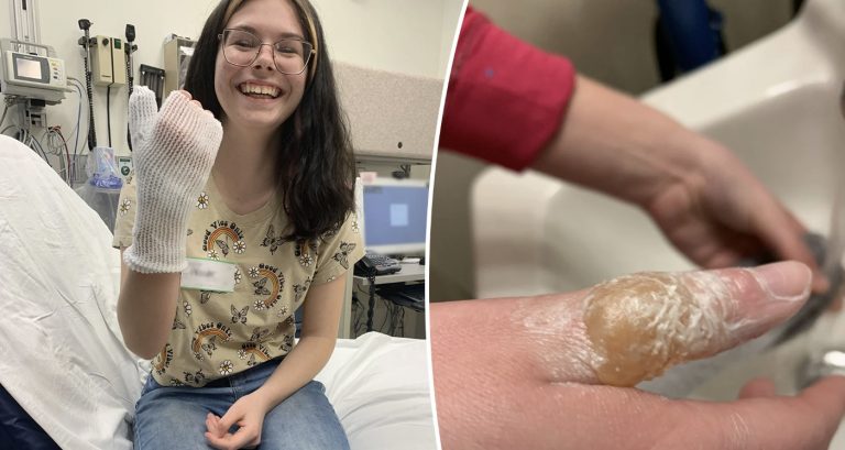 ΗΠΑ: Έφηβη έπαθε σοβαρά εγκαύματα αφού μιμήθηκε βίντεο στο TikTok