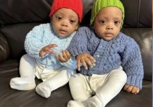 Μεγάλη Βρετανία: Σιαμαία δίδυμα που διαχωρίστηκαν με επιτυχία γιόρτασαν τα πρώτα τους γενέθλια