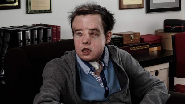 Πέθανε σε ηλικία 49 ετών «ο άνθρωπος με τα τρία πρόσωπα»