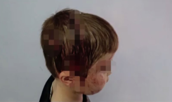 Γιαννιτσά: Μεγαλόσωμος σκύλος δάγκωσε 6χρονο στο κεφάλι