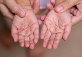 Καναδάς: Ένα παιδί πέθανε από ιλαρά, κάτι που συμβαίνει για πρώτη φορά από το 2013