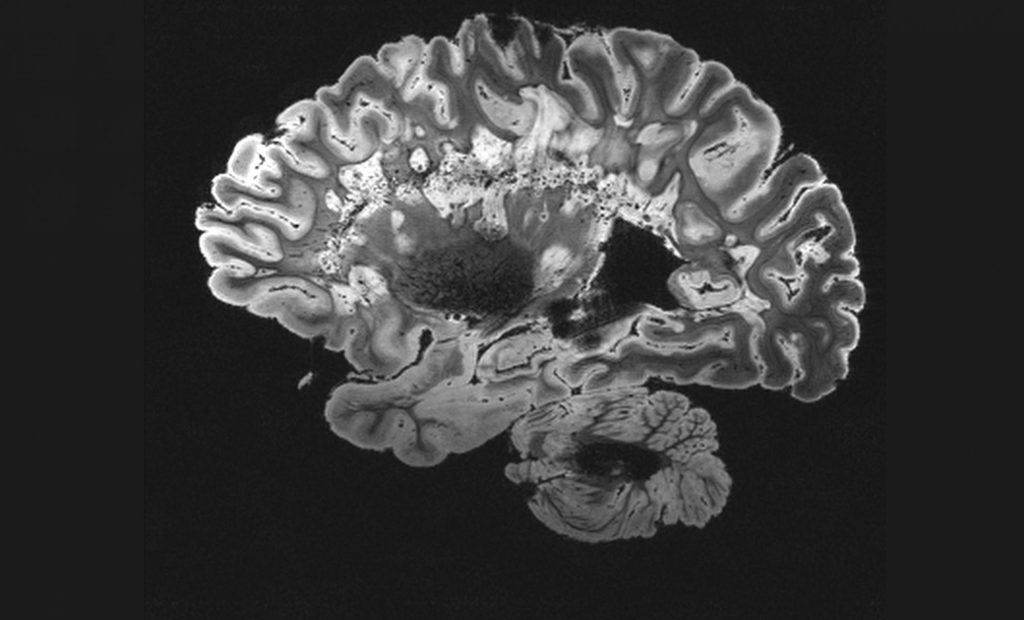 Γλοιοβλάστωμα: Εμβόλιο mRNA δίνει ελπίδα για τον θανατηφόρο καρκίνο του εγκεφάλου