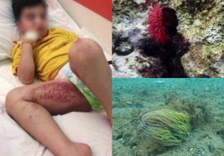 Θαλάσσιες ανεμώνες χτύπησαν κολυμβητές στο Ναύπλιο – Προκαλούν δερματικά εκζέματα