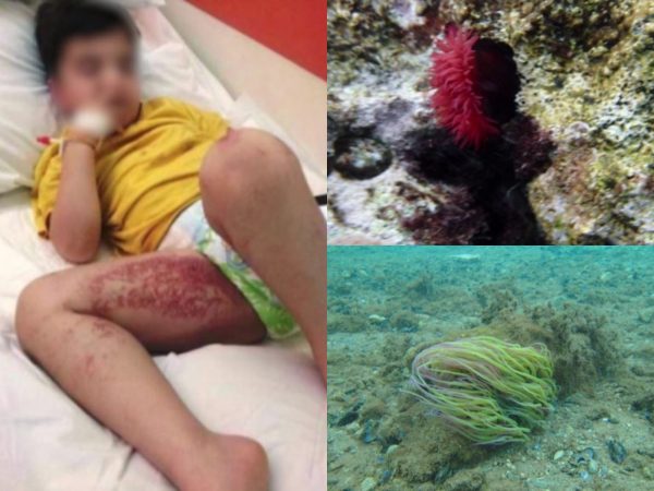 Θαλάσσιες ανεμώνες χτύπησαν κολυμβητές στο Ναύπλιο – Προκαλούν δερματικά εκζέματα