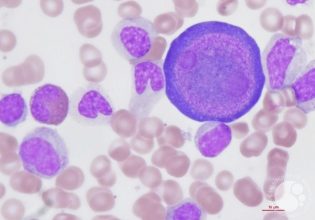 Παρβοϊός: Ποιο είναι το χαρακτηριστικό σύμπτωμα σύμφωνα με παιδίατρο – Τι λέει για τις εγκύους