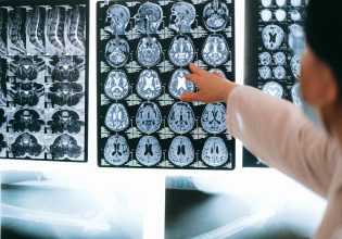 Αλτσχάιμερ: Μελέτη προτείνει νέα γενετική μορφή της νόσου