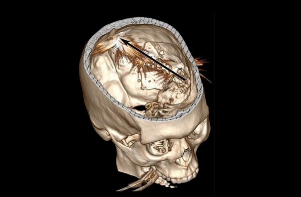 Κρήτη: Απίστευτη τύχη για αγρότη που επέζησε από πυροβολισμό στο κεφάλι