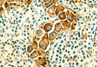 Καρκίνος του πνεύμονα: Πειραματικό εμβόλιο της Moderna