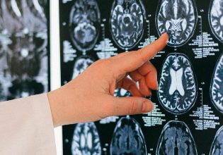 Καναδάς: Ανησυχία για μυστηριώδη ασθένεια του εγκεφάλου – Επιστήμονες καταγγέλλουν απαγόρευση μελέτης