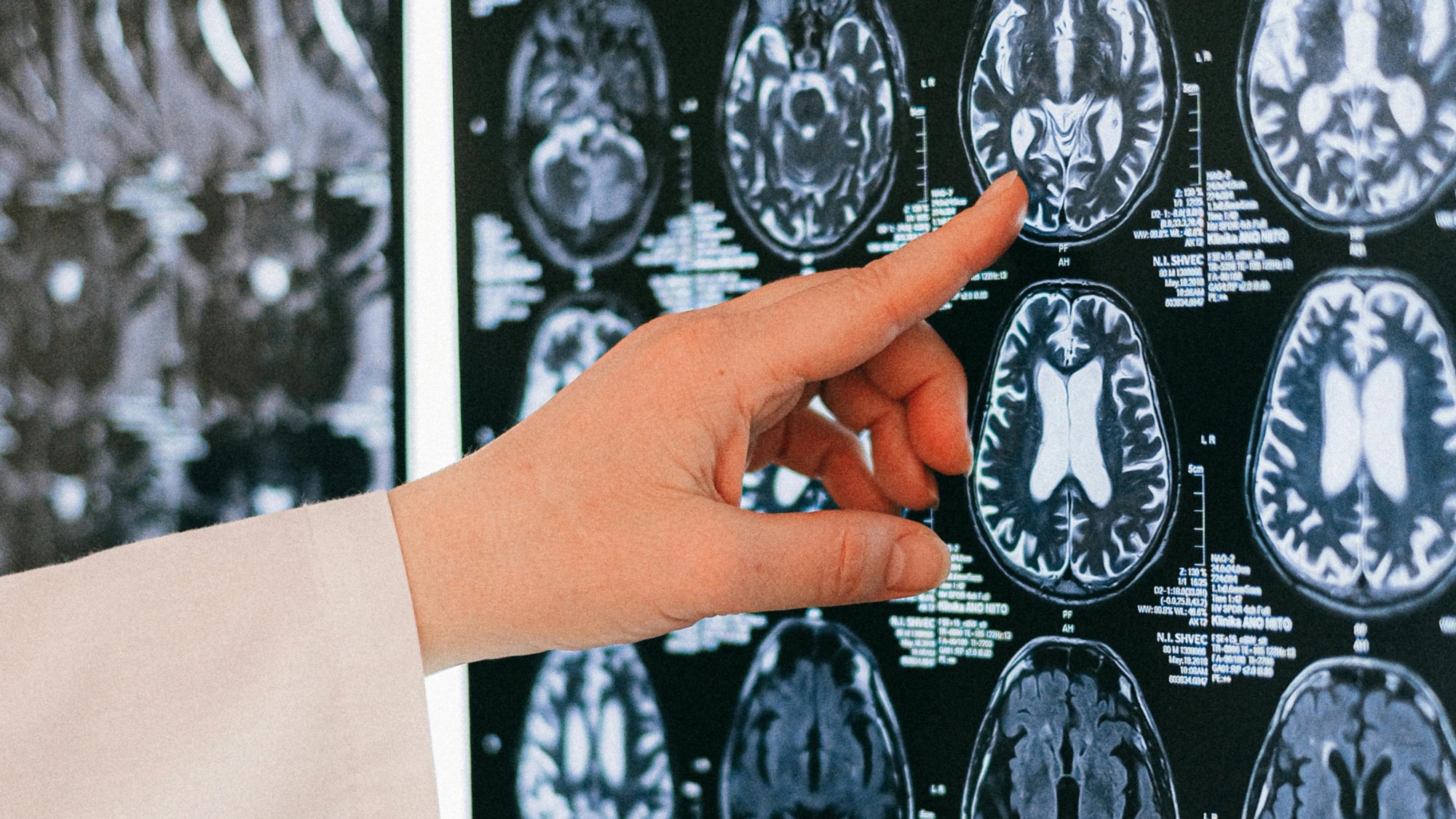 Καναδάς: Ανησυχία για μυστηριώδη ασθένεια του εγκεφάλου – Επιστήμονες καταγγέλλουν απαγόρευση μελέτης