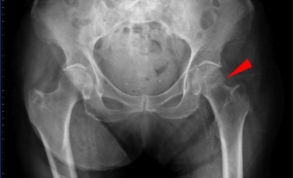 Τεχνητή νοημοσύνη προβλέπει με ακρίβεια την οστεοπόρωση