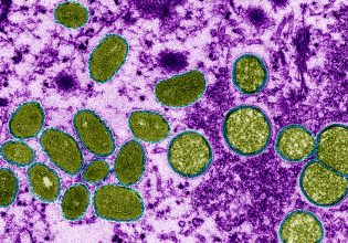 Mpox: Γιατί ο ΠΟΥ κήρυξε για δεύτερη φορά πανδημία – Ποιοι μπορούν να εμβολιαστούν στην Ελλάδα