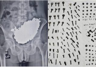 Απίστευτο ιατρικό περιστατικό – Αφαίρεσαν από το στομάχι του… 452 μεταλλικά αντικείμενα 3 κιλών!