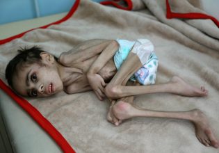 Υεμένη: Μεγάλη αύξηση του υποσιτισμού παιδιών στους τομείς που ελέγχει η διεθνώς αναγνωρισμένη κυβέρνηση