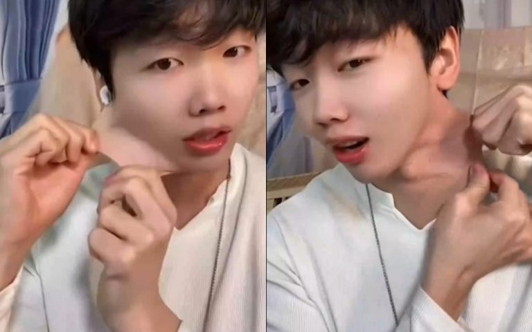 Είναι αυτός ο άνθρωπος με το πιο ελαστικό δέρμα στον κόσμο;