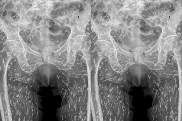 Γιατρός έμεινε άναυδος με αυτό που ανακάλυψε σε ακτινογραφία ασθενούς