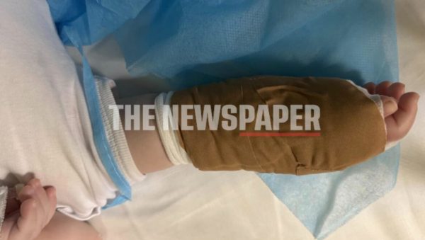 Βρέφος τριών μηνών χειρουργήθηκε με επιτυχία για σοβαρό οίδημα στο χέρι