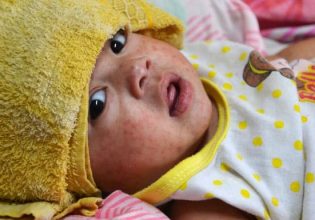 ΗΠΑ: Επιδημία ιλαράς στο Τέξας ενώ τα ποσοστά εμβολιασμού μειώνονται μετά την Covid