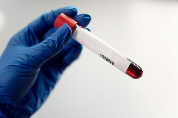 Τεστ αίματος ανιχνεύει τον καρκίνο του παγκρέατος πριν εξαπλωθεί