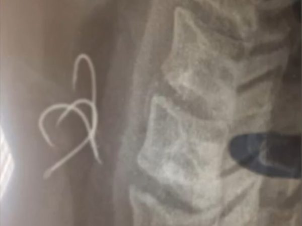 «Έγινα μπλε»: Τι λέει ο 38χρονος που κατάπιε αγκίστρια – Δεν τον αναλάμβανε κανένα νοσοκομείο για 5 ώρες