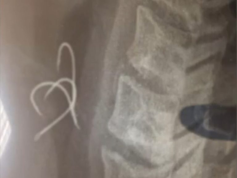 «Έγινα μπλε»: Τι λέει ο 38χρονος που κατάπιε αγκίστρια – Δεν τον αναλάμβανε κανένα νοσοκομείο για 5 ώρες