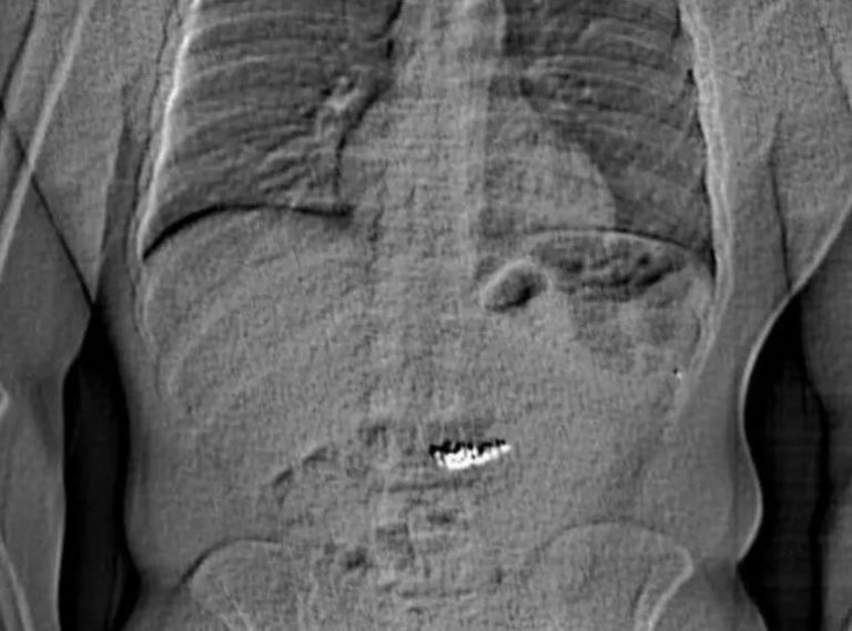 ΗΠΑ: Ληστής κατάπιε σκουλαρίκια για να… τα κρύψει από την αστυνομία