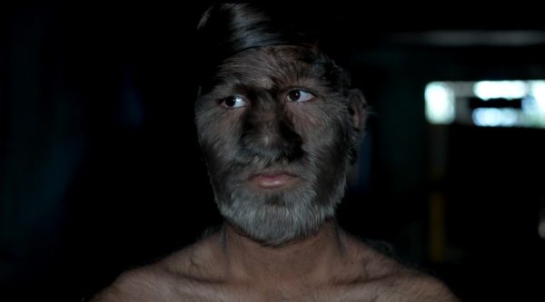 Στα ρεκόρ Γκίνες το αγόρι με τον σύνδρομο λυκάνθρωπου