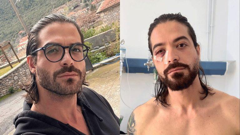 Άρης Μουγκοπέτρος: Θα καταθέσει μήνυση για απόπειρα ανθρωποκτονίας εναντίον του φίλου που του έδωσε την κροτίδα