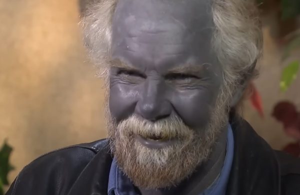 Η υπόθεση ενός «Μπαμπαστρούμφ» – Η σπάνια ασθένεια που κάνει το δέρμα μπλε