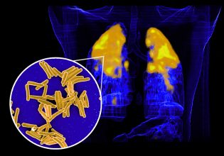 Αυξάνεται η φυματίωση στην Ελλάδα