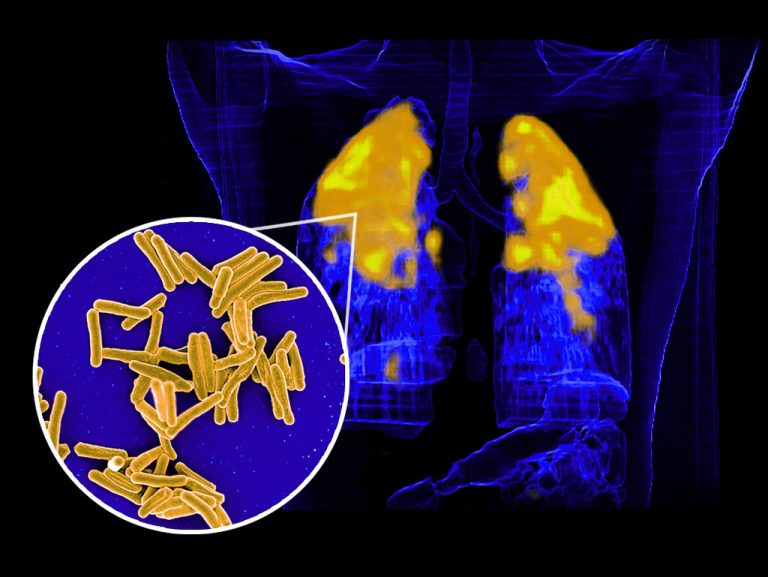 Αυξάνεται η φυματίωση στην Ελλάδα