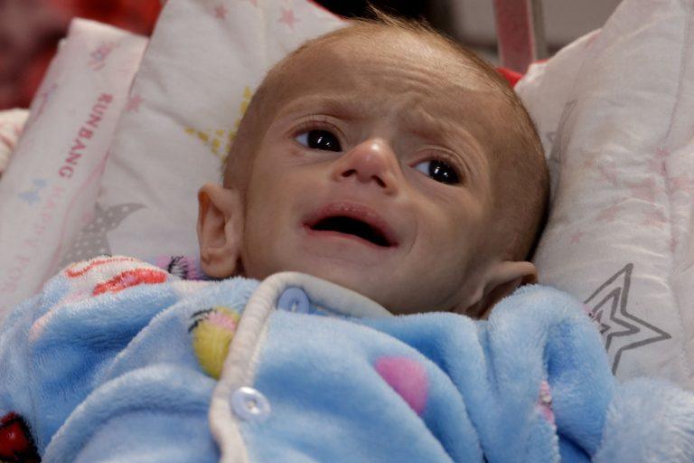 ΠΟΥ: Μια ολόκληρη γενιά στη Γάζα θα υποστεί μόνιμες βλάβες από τον υποσιτισμό