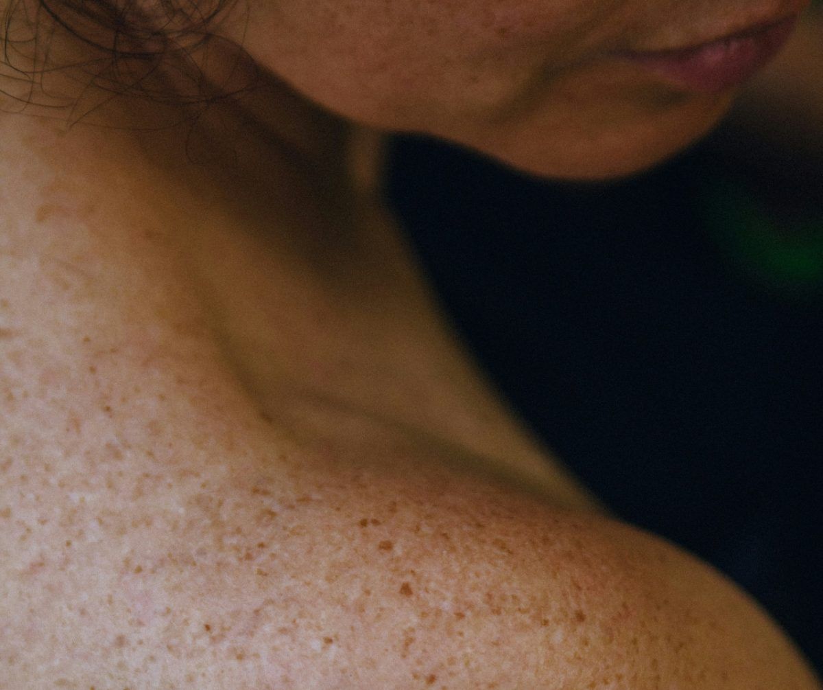 Καρκίνος του δέρματος: Πώς διαφέρει η εμφάνιση του σε άνδρες και γυναίκες