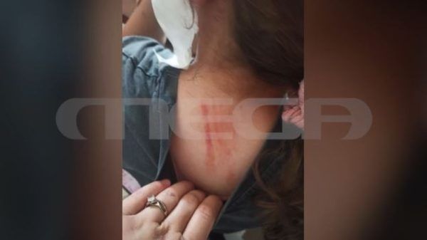 Πέλλα: Άγρια επίθεση αδέσποτου σκύλου σε 10χρονη – «Την άρπαξε από το αυτί»