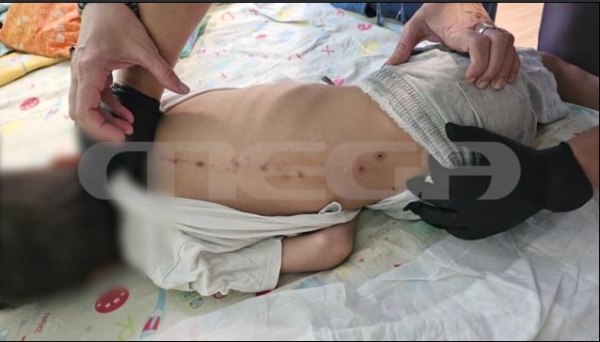 Θρίλερ με σημάδια στην πλάτη 7χρονου – Τι ερευνά η αστυνομία