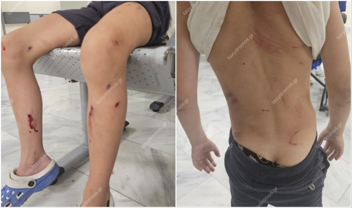 Βόλος: Αδέσποτα σκυλιά επιτέθηκαν σε 7χρονο αγόρι