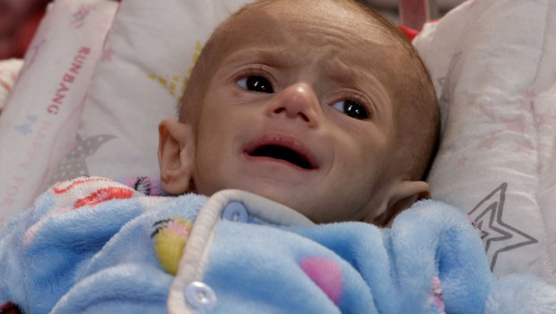 Γάζα: «Ό,τι έχει απομείνει είναι μόνο δέρμα και κόκαλα» – Η αδυσώπητη πραγματικότητα για τα παιδιά